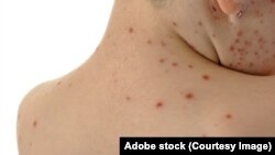 تعداد زیادی از اطفال به این بیماری مبتلا شده اند