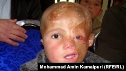 تصویر آرشیف: یکی از اطفالی که سوخته گی عمیق داشت و برای تداوی به آلمان فرستاده شده