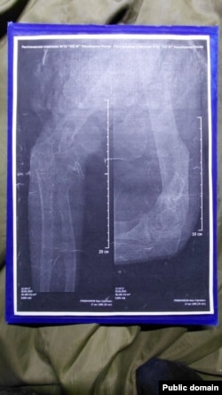 Снимки сломанной руки Ивана Гребенникова