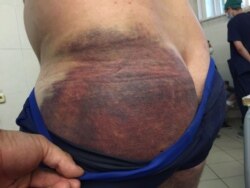 Сліди побоїв на тілі людини, якого звільнили з ізолятора, в відділенні травматології однієї з мінських лікарень. 15 серпня 2020 року