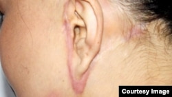 Пластикалык операциядан жабыркаган келин.